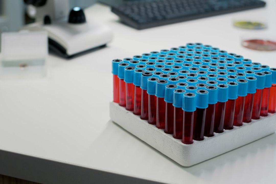  HB Electrophoresis Test